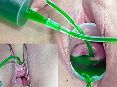 Cervix and Pee Hole Inflation with Injections for Japanese Lesbians